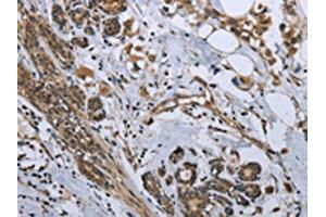 The image on the left is immunohistochemistry of paraffin-embedded Human breast cancer tissue using ABIN7129587(GDF3 Antibody) at dilution 1/25, on the right is treated with fusion protein.