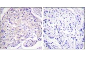 Immunohistochemistry analysis of paraffin-embedded human breast carcinoma, using PAK1 (Phospho-Thr212) Antibody. (PAK1 anticorps  (pThr212))
