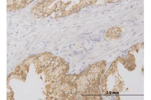 Immunoperoxidase of monoclonal antibody to RIPK2 on formalin-fixed paraffin-embedded human prostate. (RIPK2 anticorps  (AA 431-540))