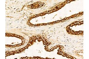 ABIN7094814 and ABIN7098865 at 1/100 staining Human colorectal cancer by IHC-P. (Filaggrin anticorps  (C-Term))