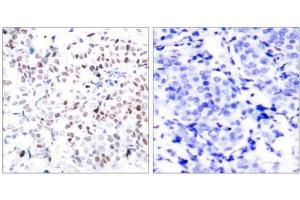 Immunohistochemical analysis of paraffin-embedded human breast carcinoma tissue using Myc(Phospho-Thr358) Antibody(left) or the same antibody preincubated with blocking peptide(right). (c-MYC anticorps  (pThr358))