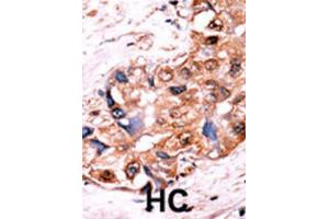 Immunohistochemistry (IHC) image for anti-V-Yes-1 Yamaguchi Sarcoma Viral Oncogene Homolog 1 (YES1) (pTyr530), (pTyr537) antibody (ABIN2970974) (YES1 anticorps  (pTyr530, pTyr537))