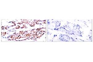 Immunohistochemical analysis of paraffin-embedded human breast carcinoma tissue using JunB (phospho- Ser79) antibody (E011026). (JunB anticorps  (pSer79))