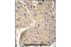 Formalin-fixed and paraffin-embedded human hepatocarcinoma tissue reacted with PTPN7 Antibody (S44) (ABIN391869 and ABIN2841694) , which was peroxidase-conjugated to the secondary antibody, followed by DAB staining.