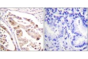 Immunohistochemistry analysis of paraffin-embedded human lung carcinoma tissue, using RFA2 (Ab-21) Antibody.