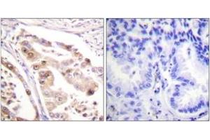 Immunohistochemistry analysis of paraffin-embedded human lung carcinoma tissue, using RFA2 (Ab-21) Antibody. (RPA2 anticorps  (AA 10-59))