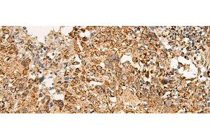 Immunohistochemistry of paraffin-embedded Human cervical cancer tissue using ATP5I Polyclonal Antibody at dilution of 1:65(x200)