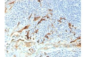 Formalin-fixed, paraffin-embedded human endometrial carcinoma stained with Biotin-conjugated Mesothelin Mouse Monoclonal Antibody (MSLN/2131). (Mesothelin anticorps  (AA 273-407) (Biotin))