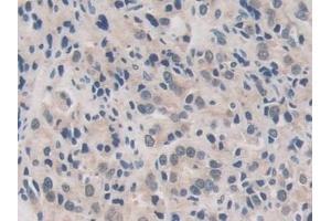 Detection of USP7 in Human Prostate cancer Tissue using Polyclonal Antibody to Ubiquitin Specific Peptidase 7 (USP7)