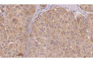 ABIN6277526 at 1/100 staining Human Melanoma tissue by IHC-P. (BPI anticorps  (Internal Region))