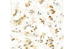 Immunohistochemistry of paraffin embedded human breast cancer using SIX1 (ABIN7075617) at dilution of 1: 650 (400x lens) (SIX Homeobox 1 anticorps)