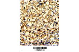 Formalin-fixed and paraffin-embedded human breast carcinoma with ADRA2B Antibody , which was peroxidase-conjugated to the secondary antibody, followed by DAB staining.