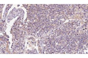 ABIN6273167 at 1/100 staining Human lymph cancer tissue by IHC-P. (SRP14 anticorps  (Internal Region))