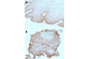 Immunohistochemical staining (Formalin-fixed paraffin-embedded sections) of human cervical carcinoma (A) and human bladder carcinoma (B) with FAT2 monoclonal antibody, clone 8C5 . (FAT Atypical Cadherin 2 (FAT2) anticorps)