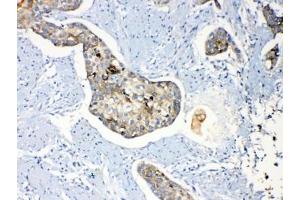 IHC testing of FFEP human esophagus squama cancer tissue with Periplakin antibody at 1ug/ml.