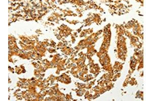 The image on the left is immunohistochemistry of paraffin-embedded Human gastric cancer tissue using ABIN7190727(FZD6 Antibody) at dilution 1/60, on the right is treated with synthetic peptide. (FZD6 anticorps)