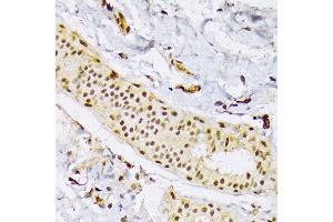 Immunohistochemistry of paraffin-embedded Human mammary cancer using SRSF3 antibody (ABIN6132649, ABIN6148465, ABIN6148466 and ABIN6221693) at dilution of 1:100 (40x lens).