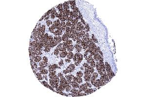 Strong membranous CD56 staining in a neuroendocrine tumor of the lung (Recombinant CD56 anticorps)