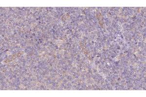 ABIN6273074 at 1/100 staining Human lymph cancer tissue by IHC-P. (SNAPIN anticorps  (N-Term))