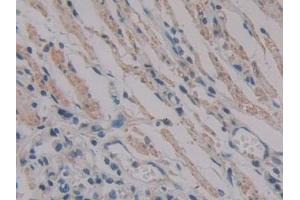 Detection of PKIb in Human Stomach cancer Tissue using Polyclonal Antibody to Protein Kinase Inhibitor Beta (PKIb) (PKIB anticorps  (AA 8-76))