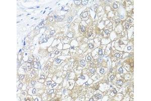 Immunohistochemistry of paraffin-embedded Human liver cancer using ASL Polyclonal Antibody at dilution of 1:100 (40x lens).
