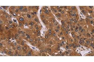 Immunohistochemistry of paraffin-embedded Human liver cancer using PPIB Polyclonal Antibody at dilution of 1:45 (PPIB anticorps)