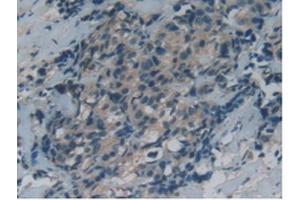 IHC-P analysis of Human Thyroid Cancer Tissue, with DAB staining. (GAS6 anticorps  (AA 136-311))