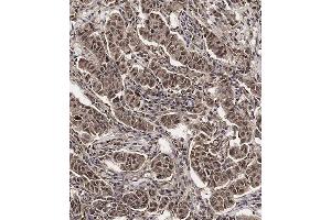 Immunohistochemical analysis of (ABIN654398 and ABIN2844139) on paraffin-embedded Human breast carcinoma tissue.