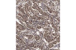 Immunohistochemical analysis of (ABIN654398 and ABIN2844139) on paraffin-embedded Human breast carcinoma tissue. (SCXA anticorps  (C-Term))
