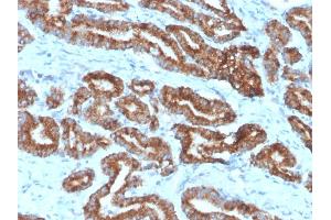 Formalin-fixed, paraffin-embedded human prostate carcinoma (10X) stained with AMACR / p504S Rabbit Monoclonal Antibody (13H4) (AMACR anticorps)