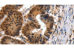 Immunohistochemistry of paraffin-embedded Human colon cancer using 14-3-3 epsilon Polyclonal Antibody at dilution of 1:100 (YWHAE anticorps)