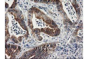 Immunohistochemical staining of paraffin-embedded Adenocarcinoma of Human colon tissue using anti-SULT1C2 mouse monoclonal antibody. (SULT1C2 anticorps)