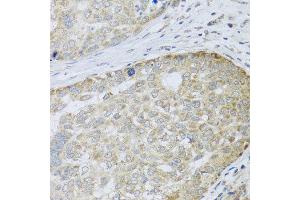 Immunohistochemistry of paraffin-embedded human liver cancer using ANAPC10 antibody at dilution of 1:100 (x40 lens). (ANAPC10 anticorps)
