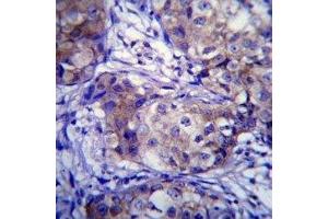 CYP1A1 antibody immunohistochemistry analysis in formalin fixed and paraffin embedded human breast carcinoma.