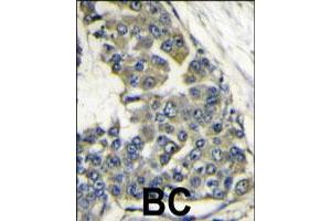 Formalin-fixed and paraffin-embedded human breast carcinoma reacted with EIF4B polyclonal antibody  , which was peroxidase-conjugated to the secondary antibody, followed by DAB staining. (EIF4B anticorps  (Internal Region))