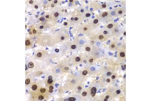 Immunohistochemistry of paraffin-embedded human liver injury using ETS1 antibody (ABIN5970774) at dilution of 1/100 (40x lens). (ETS1 anticorps)