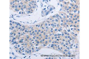 Immunohistochemistry of Human lung cancer using HOXA6 Polyclonal Antibody at dilution of 1:60 (HOXA6 anticorps)