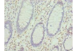 Immunohistochemistry of paraffin-embedded human colon cancer using ABIN7157478 at dilution of 1:100