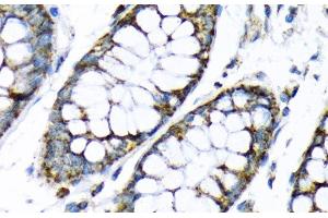 Immunohistochemistry of paraffin-embedded Human colon using HK2 Polyclonal Antibody at dilution of 1:200 (40x lens). (Hexokinase 2 anticorps)
