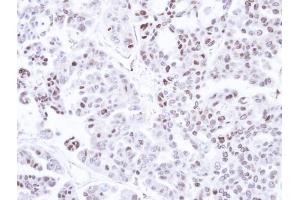 IHC-P Image Immunohistochemical analysis of paraffin-embedded OVCAR3 xenograft, using CAMK1D, antibody at 1:500 dilution. (CAMK1D anticorps)