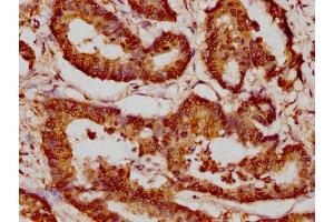 IHC image of nacHU diluted at 1:20 and staining in paraffin-embedded human colon cancer performed on a Leica BondTM system.