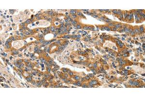 Immunohistochemistry of paraffin-embedded Human gasrtic cancer tissue using ANGPTL1 Polyclonal Antibody at dilution 1:40 (ANGPTL1 anticorps)