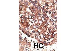 Formalin-fixed and paraffin-embedded human hepatocellular carcinoma tissue reacted with MMP13 polyclonal antibody , which was peroxidase-conjugated to the secondary antibody, followed by AEC staining.