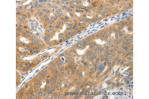 Immunohistochemistry of Human gastric cancer using SCN9A Polyclonal Antibody at dilution of 1:40 (SCN9A anticorps)