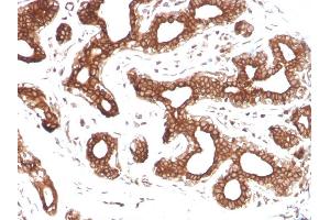 Formalin-fixed, paraffin-embedded human Breast Carcinoma stained with Calpastatin Mouse Monoclonal Antibody (CAST/1550).