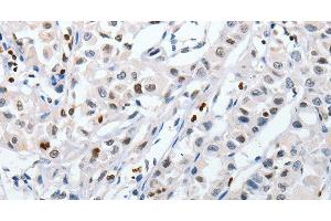 Immunohistochemistry of paraffin-embedded Human lung cancer tissue using HSPA1A Polyclonal Antibody at dilution 1:60 (HSP70 1A anticorps)