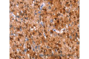 Immunohistochemistry of Human liver cancer using GH1 Polyclonal Antibody at dilution of 1:40 (Growth Hormone 1 anticorps)