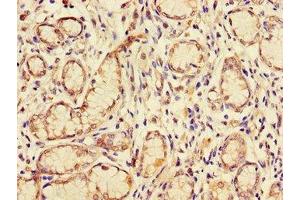 Immunohistochemistry of paraffin-embedded human gastric cancer using ABIN7153609 at dilution of 1:100 (GJB2 anticorps  (AA 99-131))