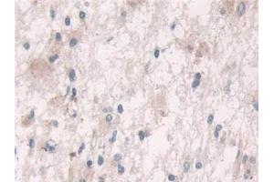Detection of Grb10 in Human Glioma Tissue using Polyclonal Antibody to Growth Factor Receptor Bound Protein 10 (Grb10)