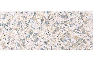 Immunohistochemistry of paraffin-embedded Human liver cancer tissue using STX6 Polyclonal Antibody at dilution of 1:60(x200) (Syntaxin 6 anticorps)